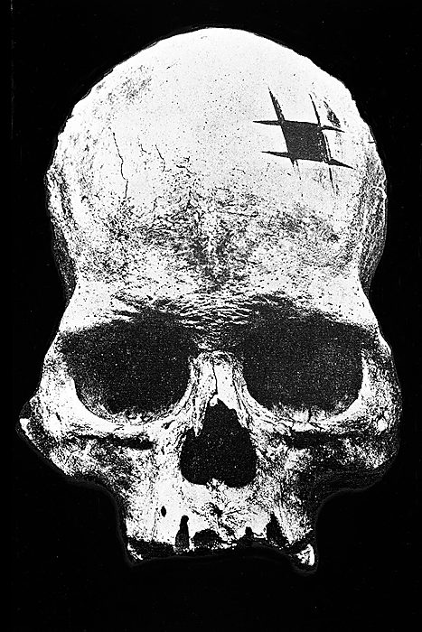 An ancient Peruvian skull with a healed trepanation
